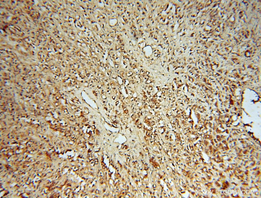 Immunohistochemistry (IHC) staining of human prostate cancer tissue using HSD17B4 Polyclonal antibody (15116-1-AP)