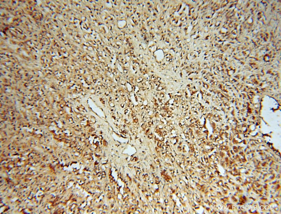 IHC staining of human prostate cancer using 15116-1-AP