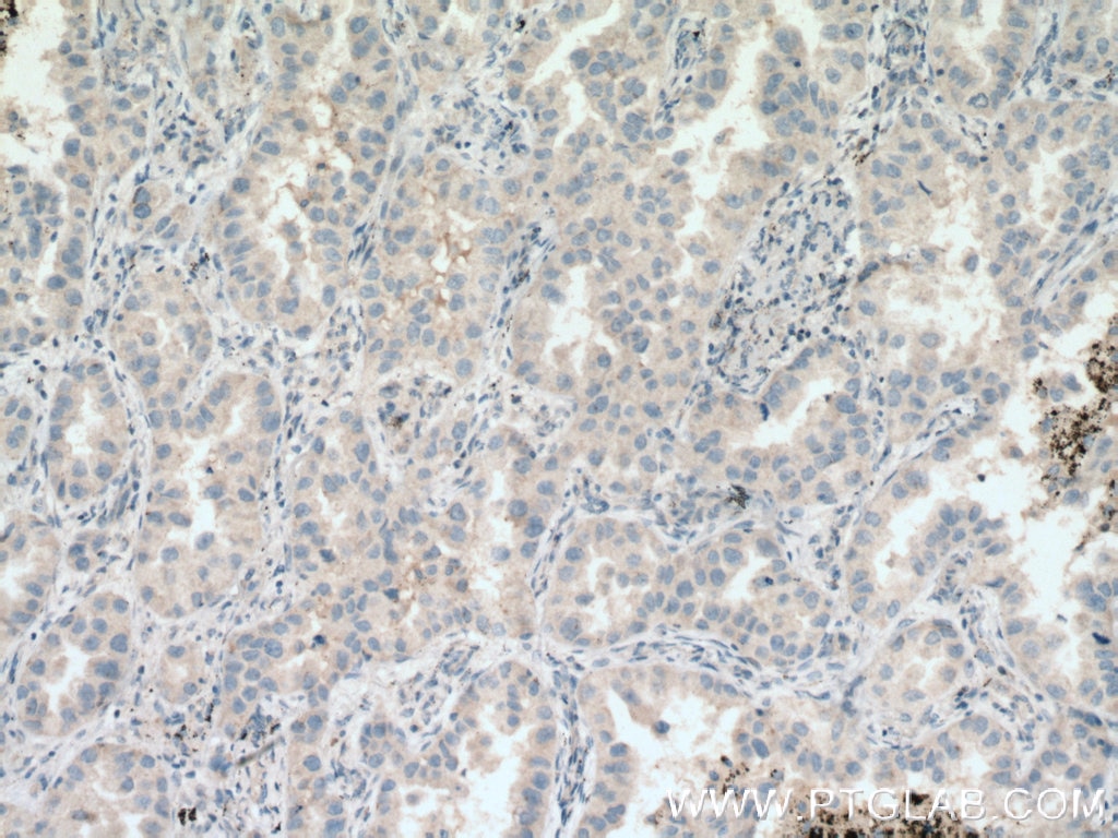 Immunohistochemistry (IHC) staining of human lung cancer tissue using HSD17B6 Polyclonal antibody (11855-1-AP)