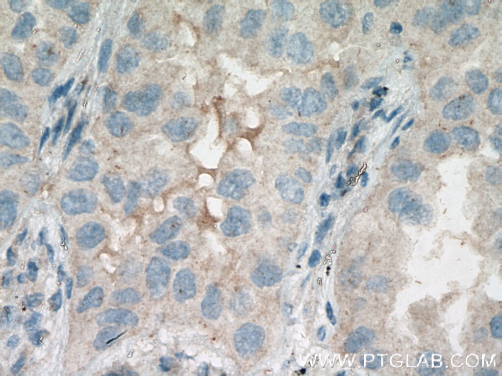 Immunohistochemistry (IHC) staining of human lung cancer tissue using HSD17B6 Polyclonal antibody (11855-1-AP)