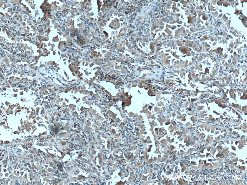 Immunohistochemistry (IHC) staining of human lung cancer tissue using HSD17B6 Polyclonal antibody (11855-1-AP)