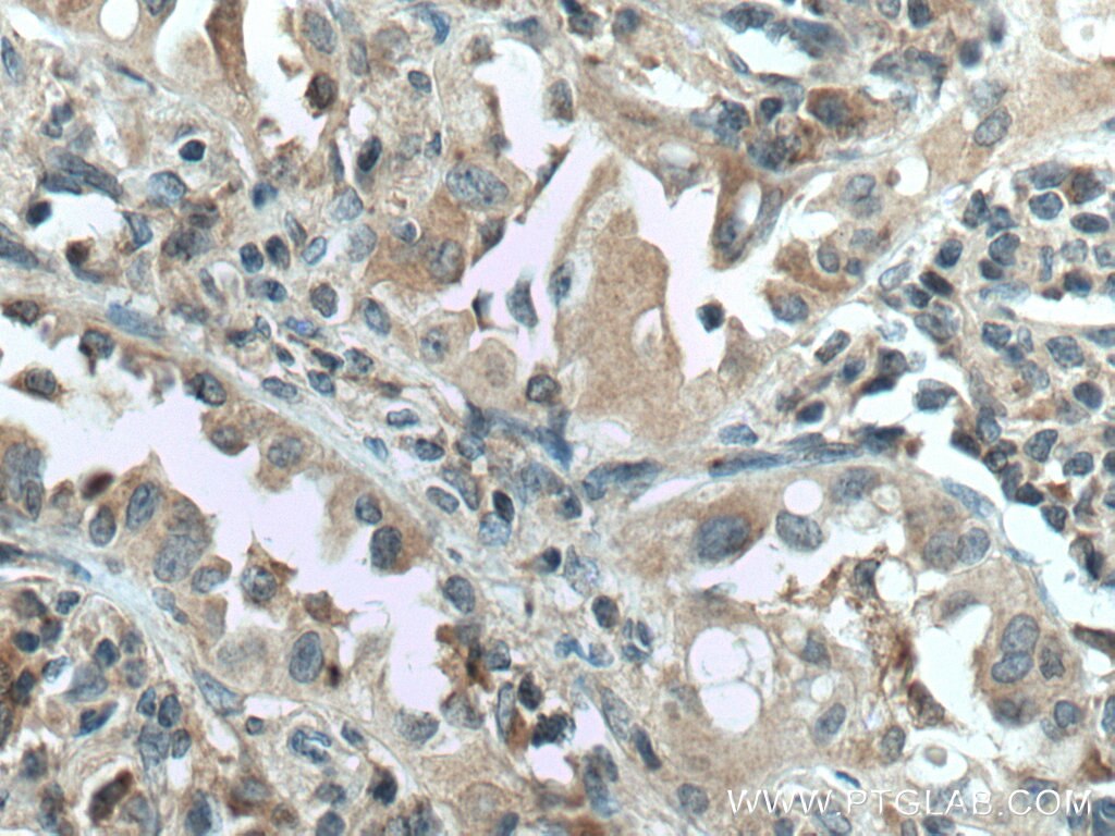 Immunohistochemistry (IHC) staining of human lung cancer tissue using HSD17B6 Polyclonal antibody (11855-1-AP)