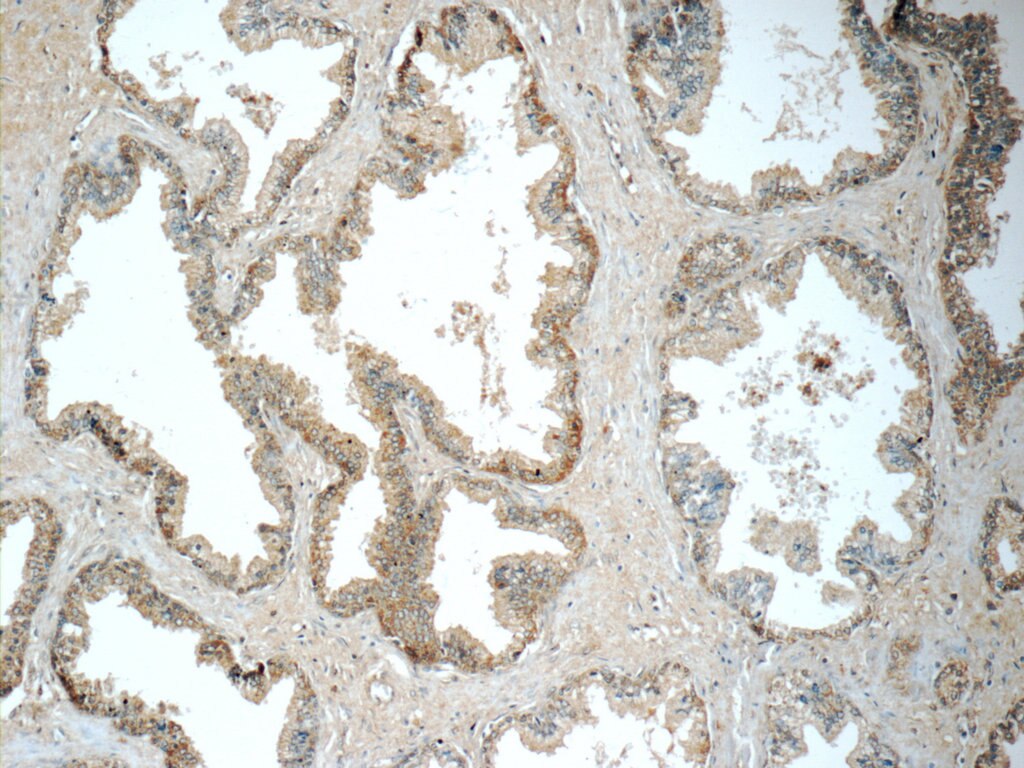 IHC staining of human prostate hyperplasia using 11855-1-AP