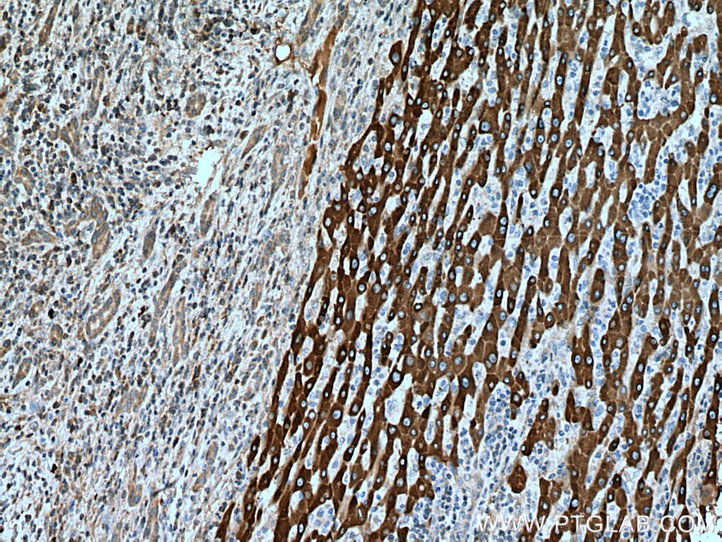 IHC staining of human liver cancer using 67496-1-Ig