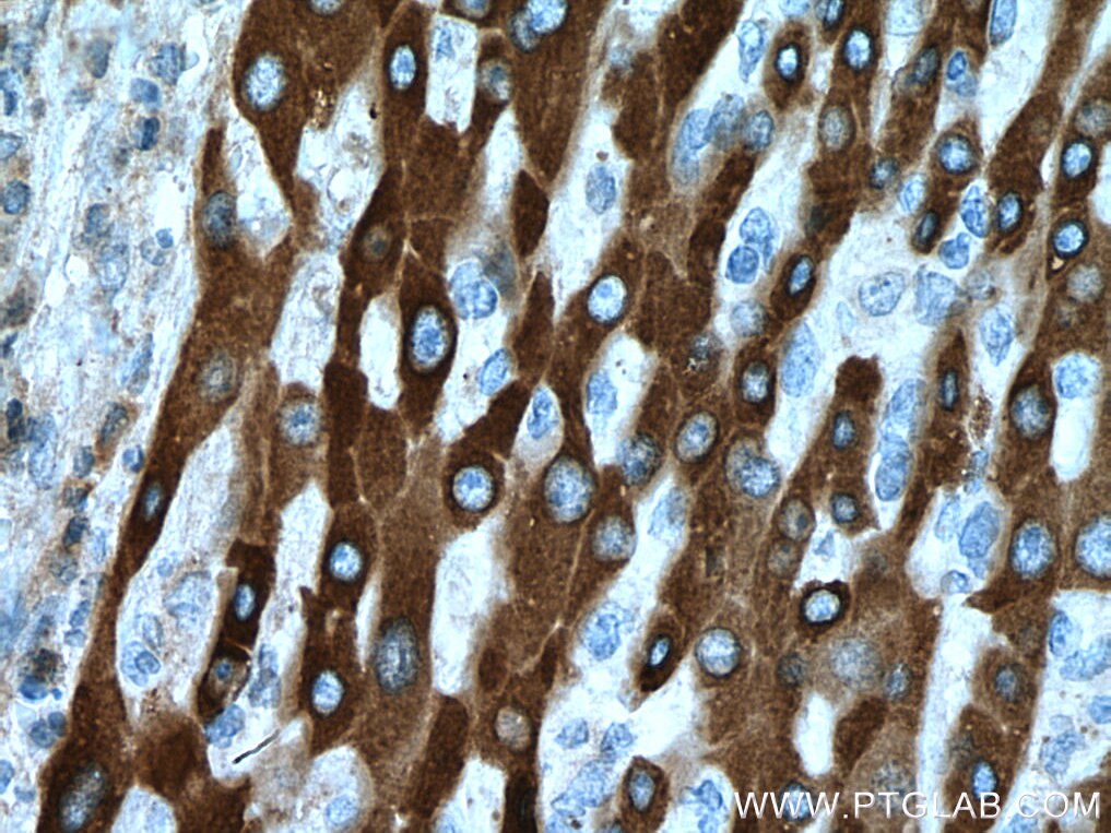 Immunohistochemistry (IHC) staining of human liver cancer tissue using HSD17B6 Monoclonal antibody (67496-1-Ig)
