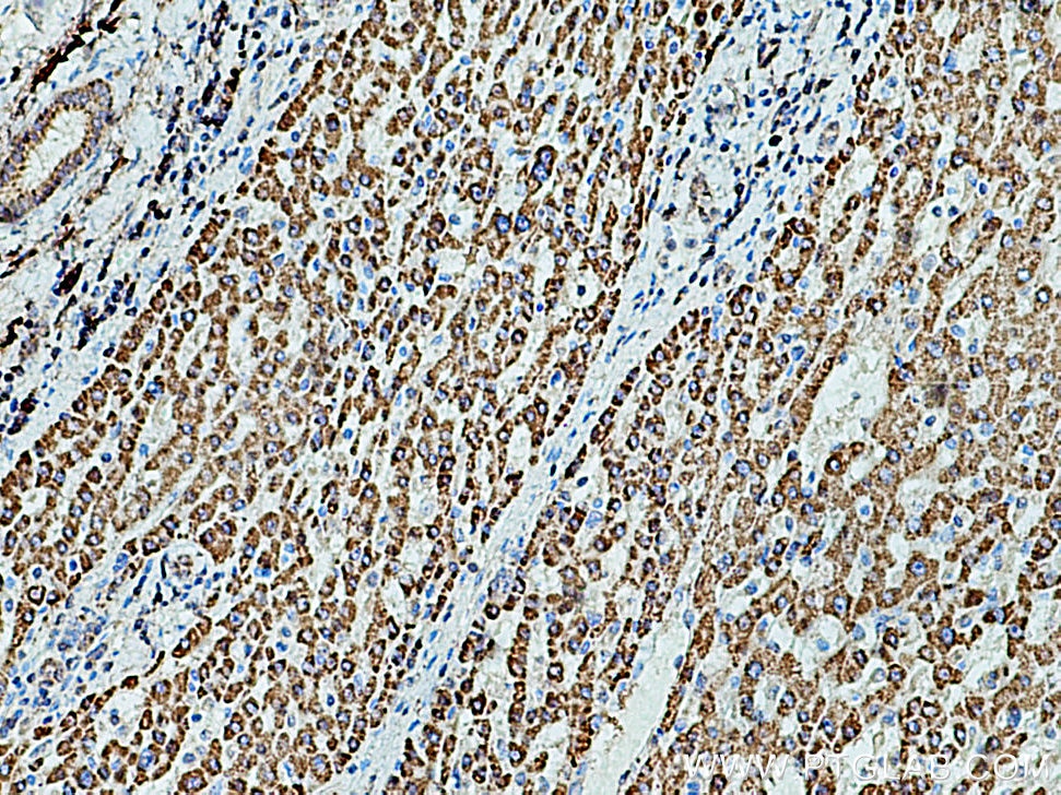 Immunohistochemistry (IHC) staining of human liver cancer tissue using HSD17B8 Polyclonal antibody (16752-1-AP)