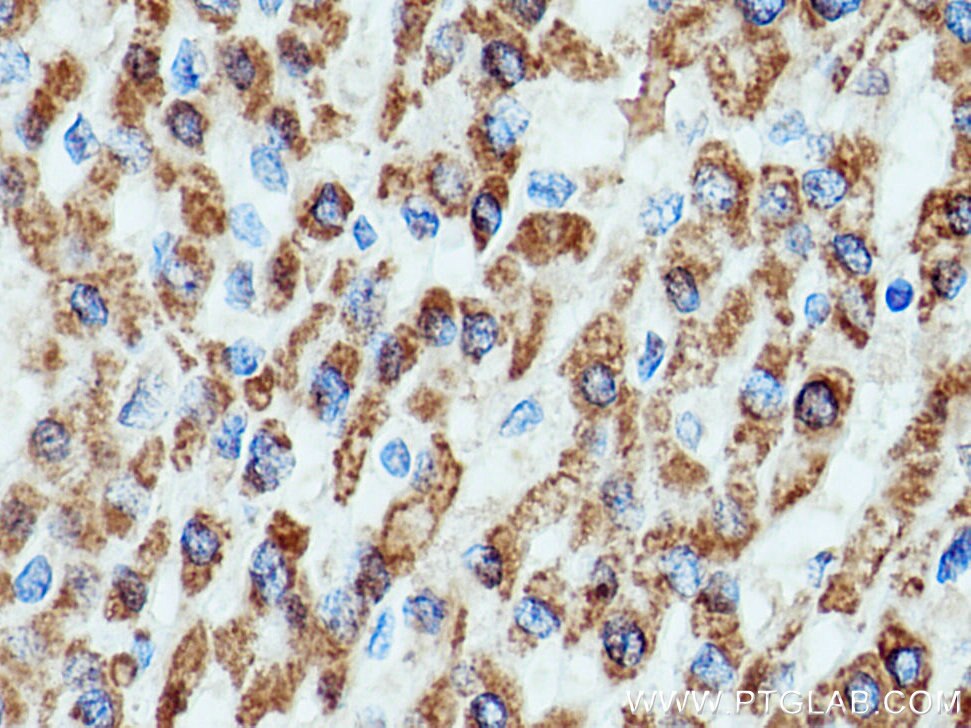 Immunohistochemistry (IHC) staining of human liver cancer tissue using HSD17B8 Polyclonal antibody (16752-1-AP)