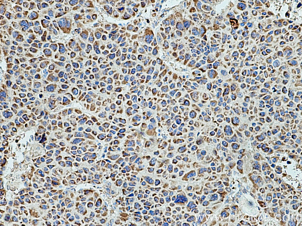 Immunohistochemistry (IHC) staining of human liver cancer tissue using HSD17B8 Polyclonal antibody (16752-1-AP)