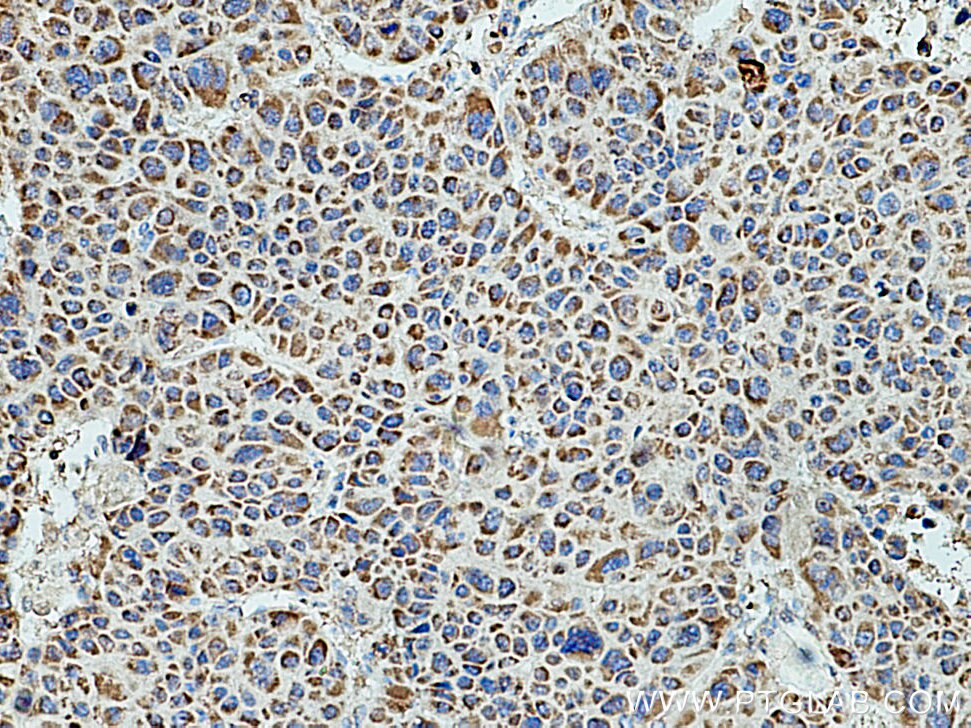 IHC staining of human liver cancer using 16752-1-AP