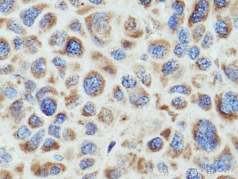 Immunohistochemistry (IHC) staining of human liver cancer tissue using HSD17B8 Polyclonal antibody (16752-1-AP)