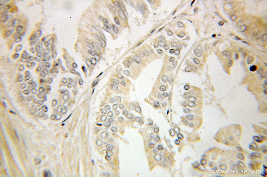Immunohistochemistry (IHC) staining of human pancreas cancer tissue using HSD3B7 Polyclonal antibody (10488-1-AP)