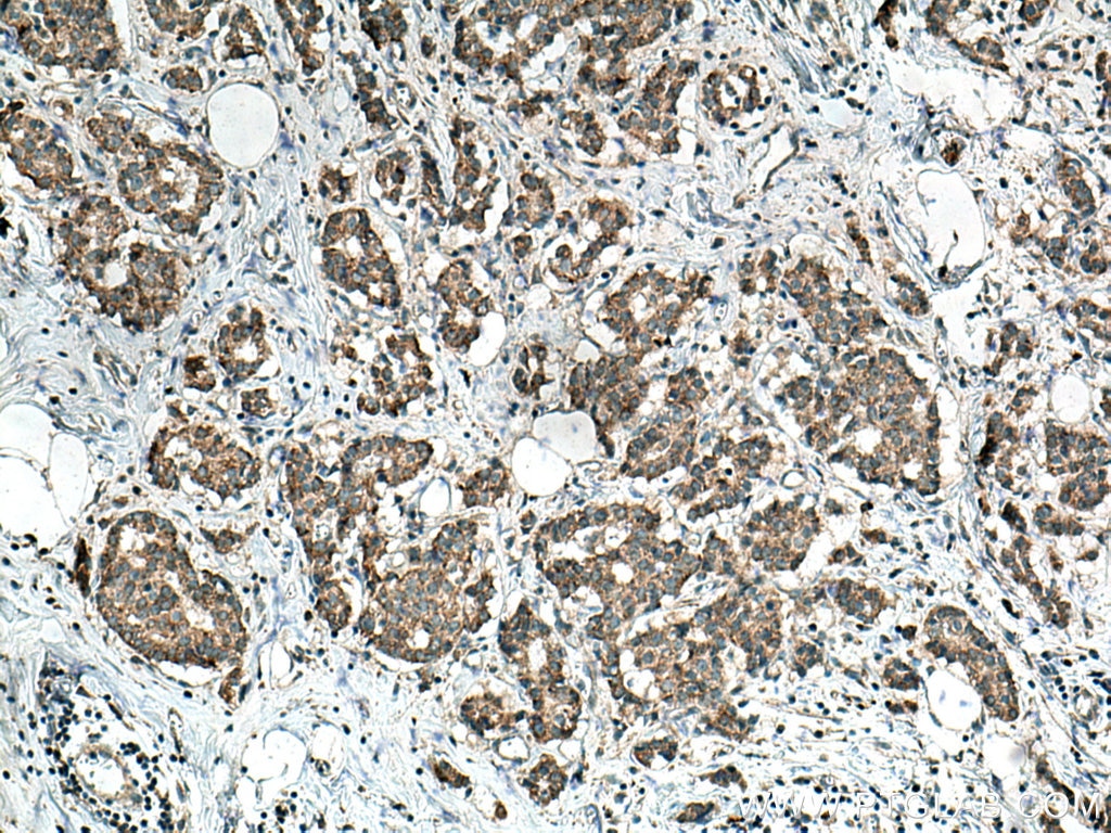 Immunohistochemistry (IHC) staining of human breast cancer tissue using HSDL1 Polyclonal antibody (16988-1-AP)