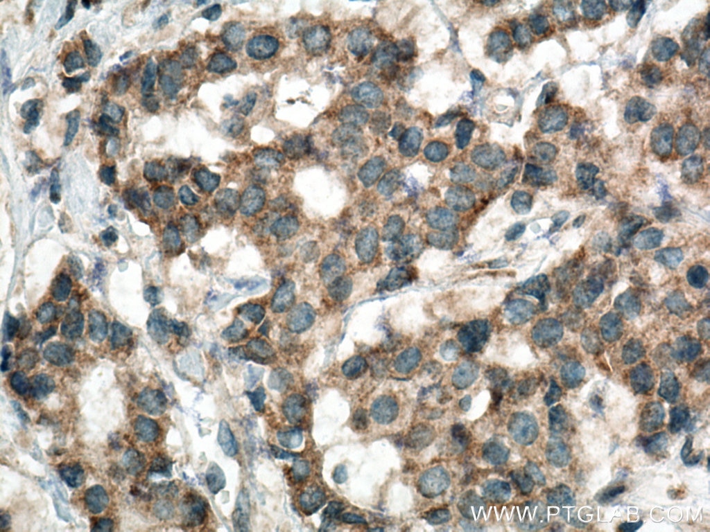 Immunohistochemistry (IHC) staining of human breast cancer tissue using HSDL1 Polyclonal antibody (16988-1-AP)