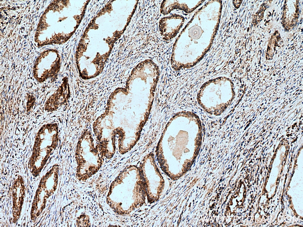 IHC staining of human prostate cancer using 15631-1-AP