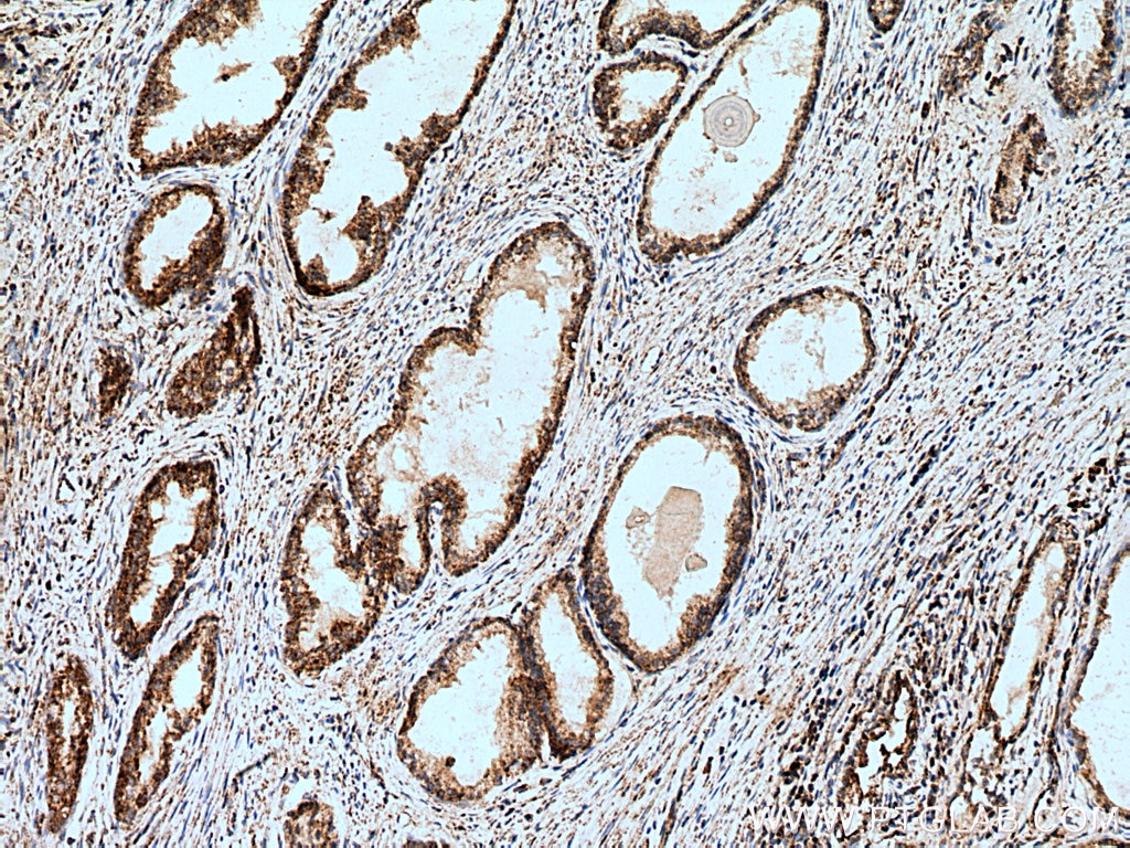 Immunohistochemistry (IHC) staining of human prostate cancer tissue using HSDL2 Polyclonal antibody (15631-1-AP)