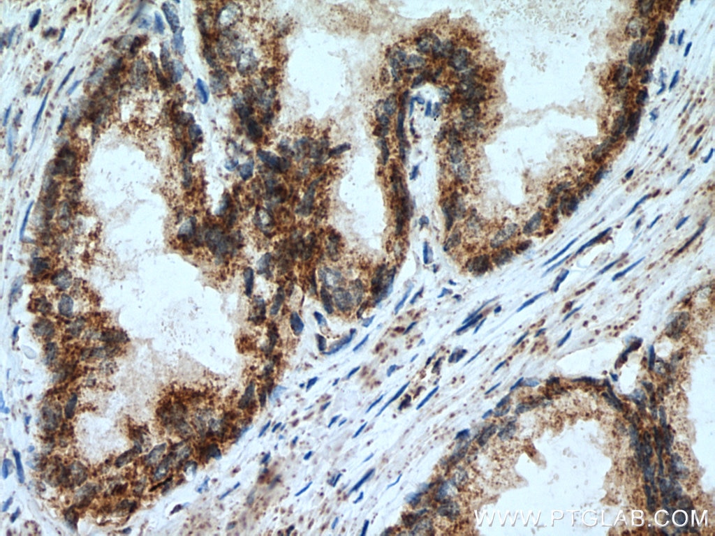 Immunohistochemistry (IHC) staining of human prostate cancer tissue using HSDL2 Polyclonal antibody (15631-1-AP)