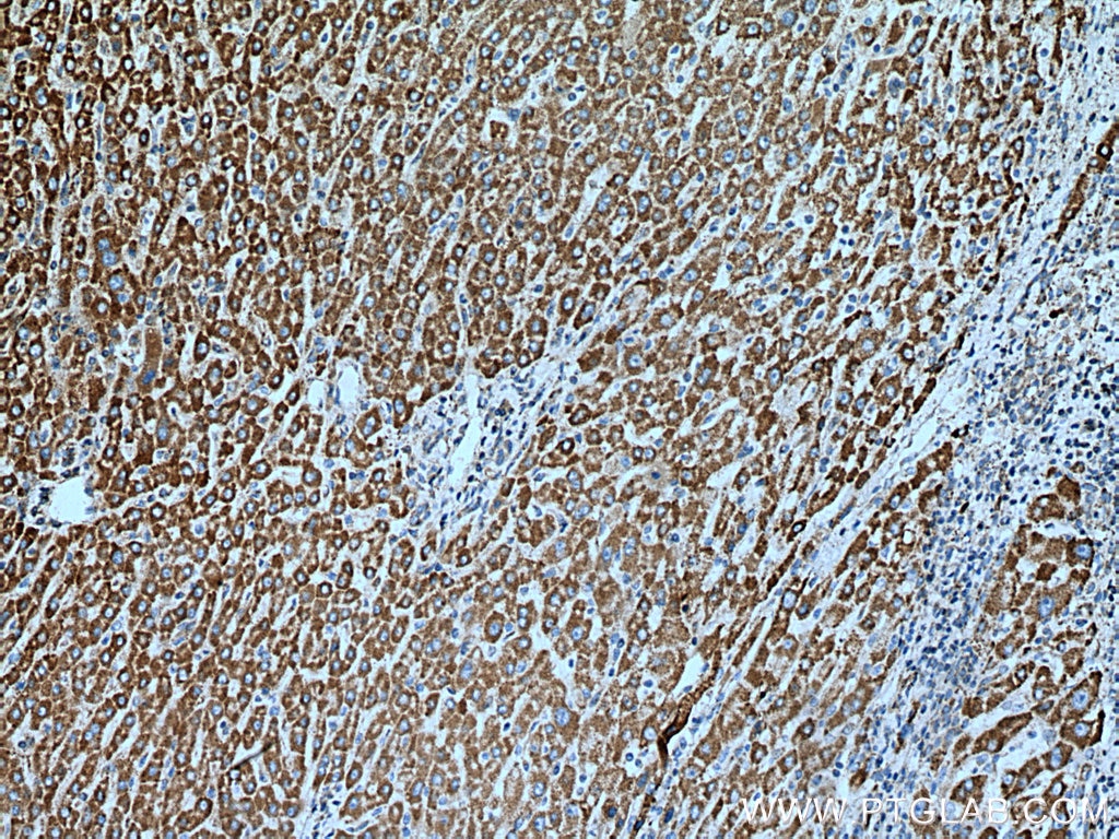 Immunohistochemistry (IHC) staining of human liver cancer tissue using HSDL2 Polyclonal antibody (15631-1-AP)