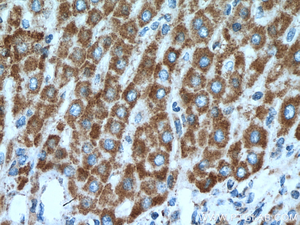 Immunohistochemistry (IHC) staining of human liver cancer tissue using HSDL2 Polyclonal antibody (15631-1-AP)
