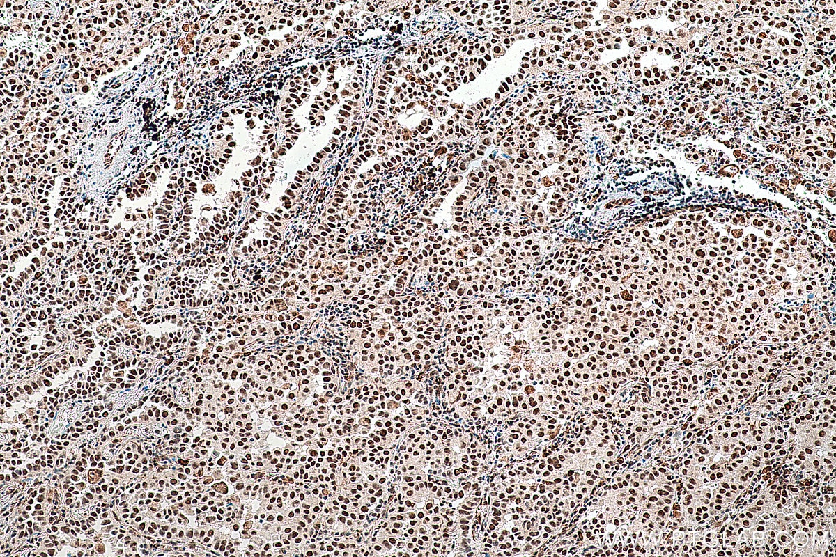 IHC staining of human lung cancer using 16107-1-AP