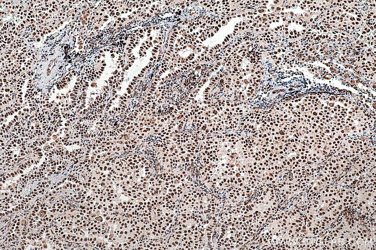 Immunohistochemistry (IHC) staining of human lung cancer tissue using HSF1 Polyclonal antibody (16107-1-AP)