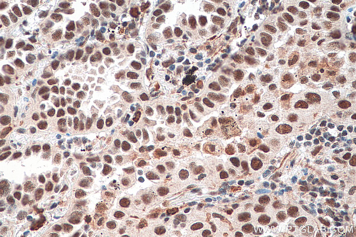 Immunohistochemistry (IHC) staining of human lung cancer tissue using HSF1 Polyclonal antibody (16107-1-AP)