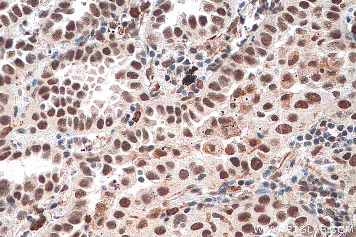 IHC staining of human lung cancer using 16107-1-AP