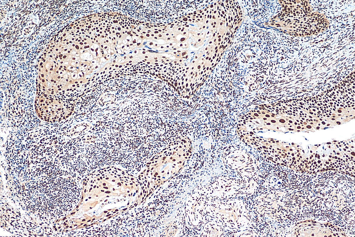 Immunohistochemistry (IHC) staining of human cervical cancer tissue using HSF1 Polyclonal antibody (16107-1-AP)