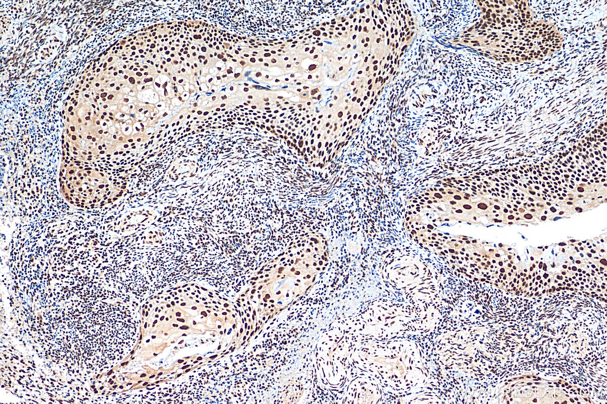 IHC staining of human cervical cancer using 16107-1-AP