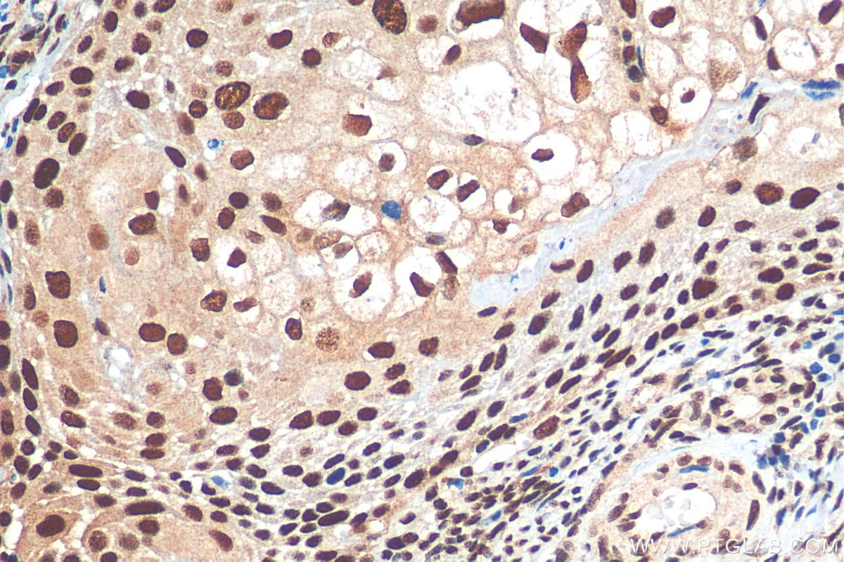 Immunohistochemistry (IHC) staining of human cervical cancer tissue using HSF1 Polyclonal antibody (16107-1-AP)