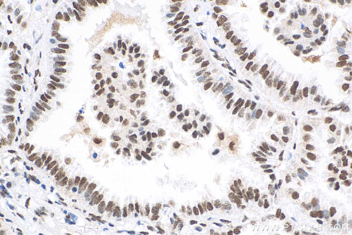 Immunohistochemistry (IHC) staining of human lung cancer tissue using HSF1 Polyclonal antibody (51034-1-AP)
