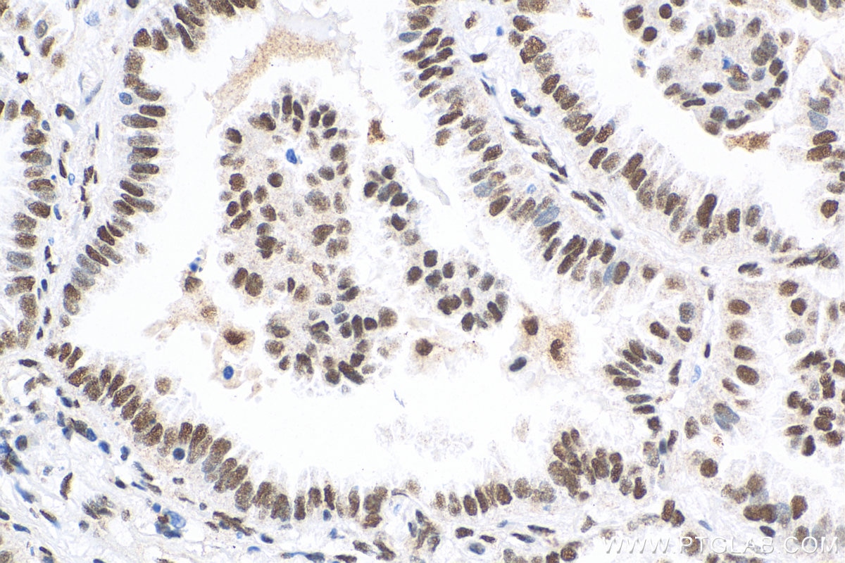 Immunohistochemistry (IHC) staining of human lung cancer tissue using HSF1 Polyclonal antibody (51034-1-AP)