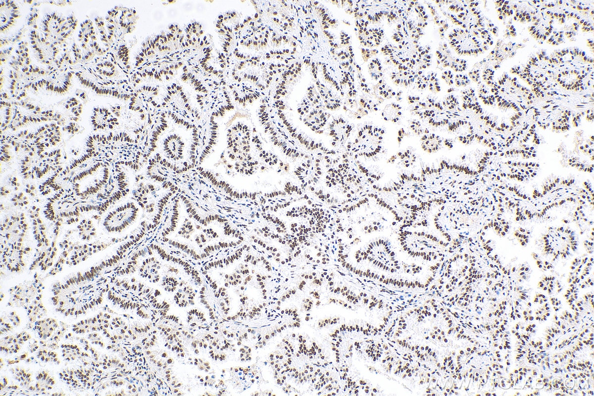 IHC staining of human lung cancer using 51034-1-AP