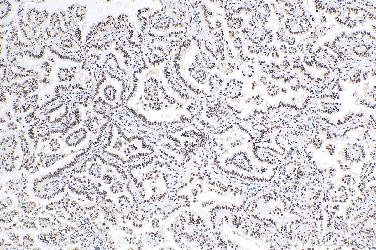 Immunohistochemistry (IHC) staining of human lung cancer tissue using HSF1 Polyclonal antibody (51034-1-AP)