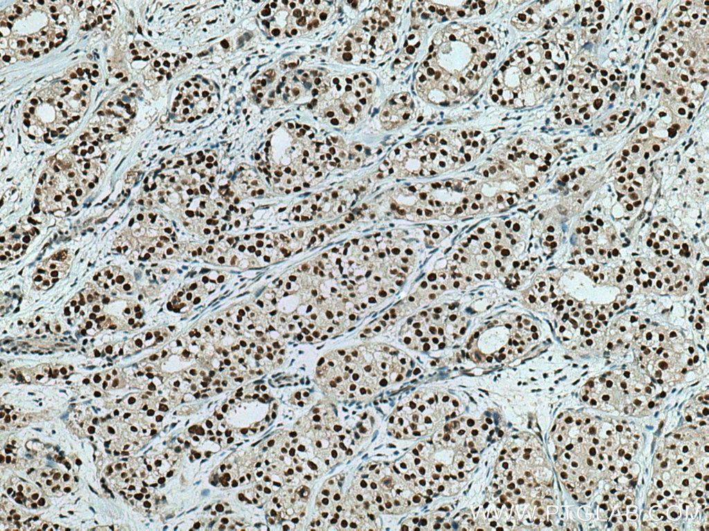 Immunohistochemistry (IHC) staining of human breast cancer tissue using HSF1 Monoclonal antibody (67189-1-Ig)