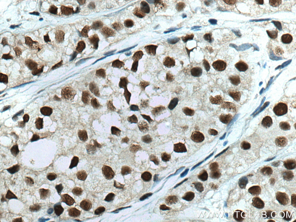Immunohistochemistry (IHC) staining of human breast cancer tissue using HSF1 Monoclonal antibody (67189-1-Ig)