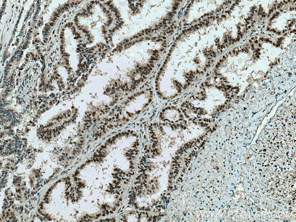 Immunohistochemistry (IHC) staining of human ovary tumor tissue using HSF1 Monoclonal antibody (67189-1-Ig)