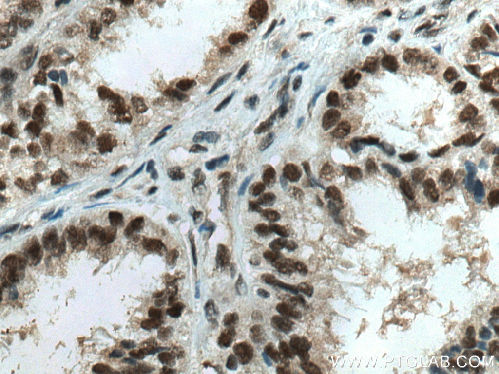 Immunohistochemistry (IHC) staining of human ovary tumor tissue using HSF1 Monoclonal antibody (67189-1-Ig)