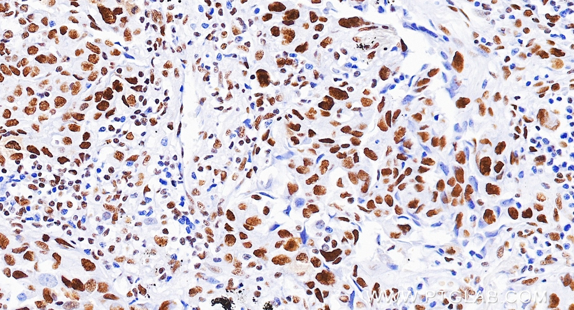 IHC staining of Human lung cancer (Adenocarcinoma) using 88318-1-RR (same clone as 88318-1-PBS) Immunohistochemistry (IHC) staining of Human lung cancer (Adenocarcinoma) using HSF1 Recombinant monoclonal antibody (88318-1-RR)