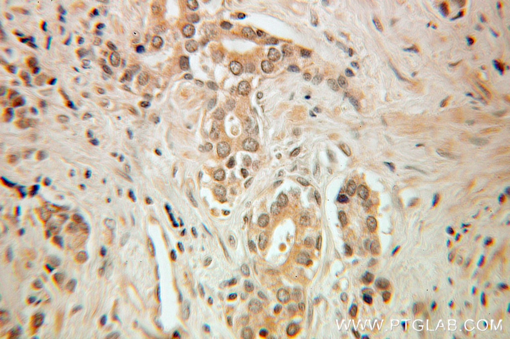 Immunohistochemistry (IHC) staining of human prostate cancer tissue using HSF2 Polyclonal antibody (10706-1-AP)