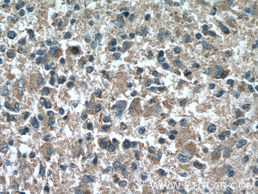 Immunohistochemistry (IHC) staining of human gliomas tissue using HSN2 Polyclonal antibody (24055-1-AP)