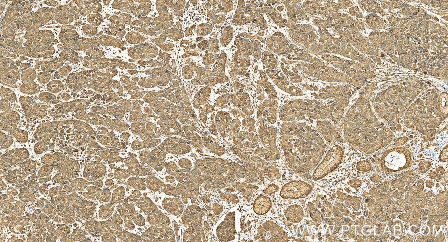 Immunohistochemistry (IHC) staining of human stomach cancer tissue using HSP27 Recombinant monoclonal antibody (80046-5-RR)