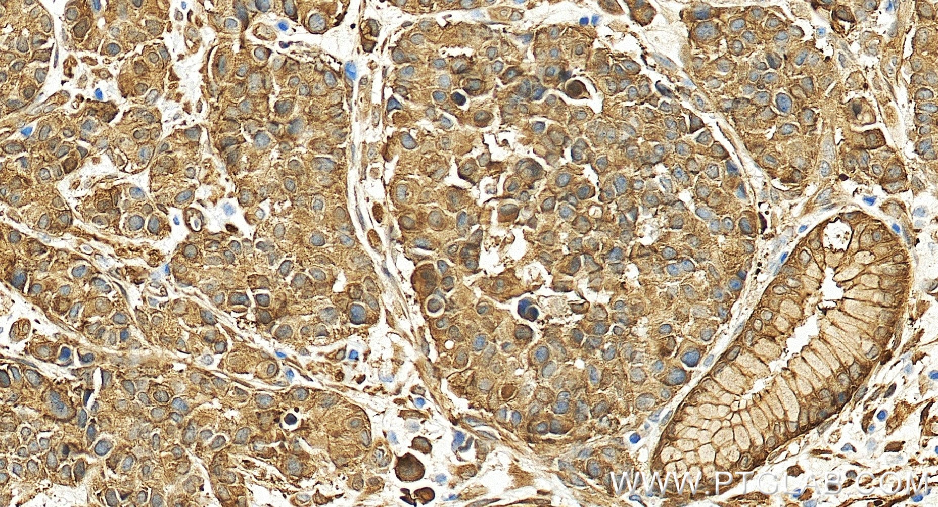 Immunohistochemistry (IHC) staining of human stomach cancer tissue using HSP27 Recombinant monoclonal antibody (80046-5-RR)