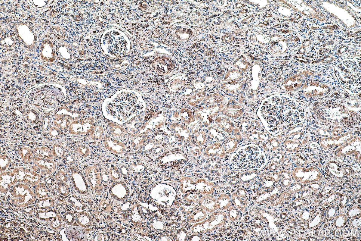 Immunohistochemistry (IHC) staining of human renal cell carcinoma tissue using HSP47 Monoclonal antibody (67863-1-Ig)