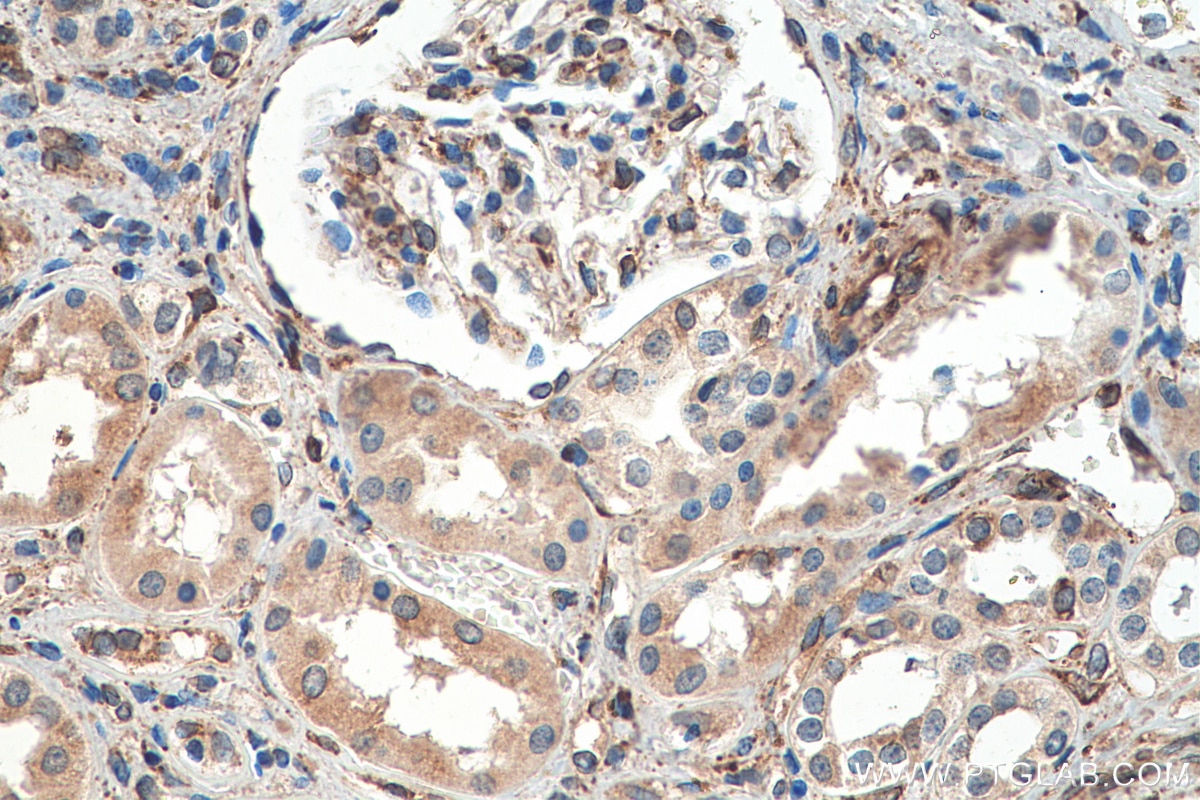 Immunohistochemistry (IHC) staining of human renal cell carcinoma tissue using HSP47 Monoclonal antibody (67863-1-Ig)