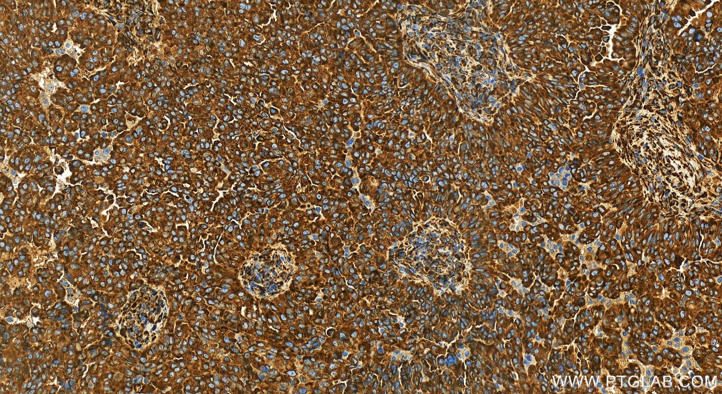Immunohistochemistry (IHC) staining of human ovarian  cancer using HSP47/SERPINH1 Recombinant antibody (83689-3-RR)