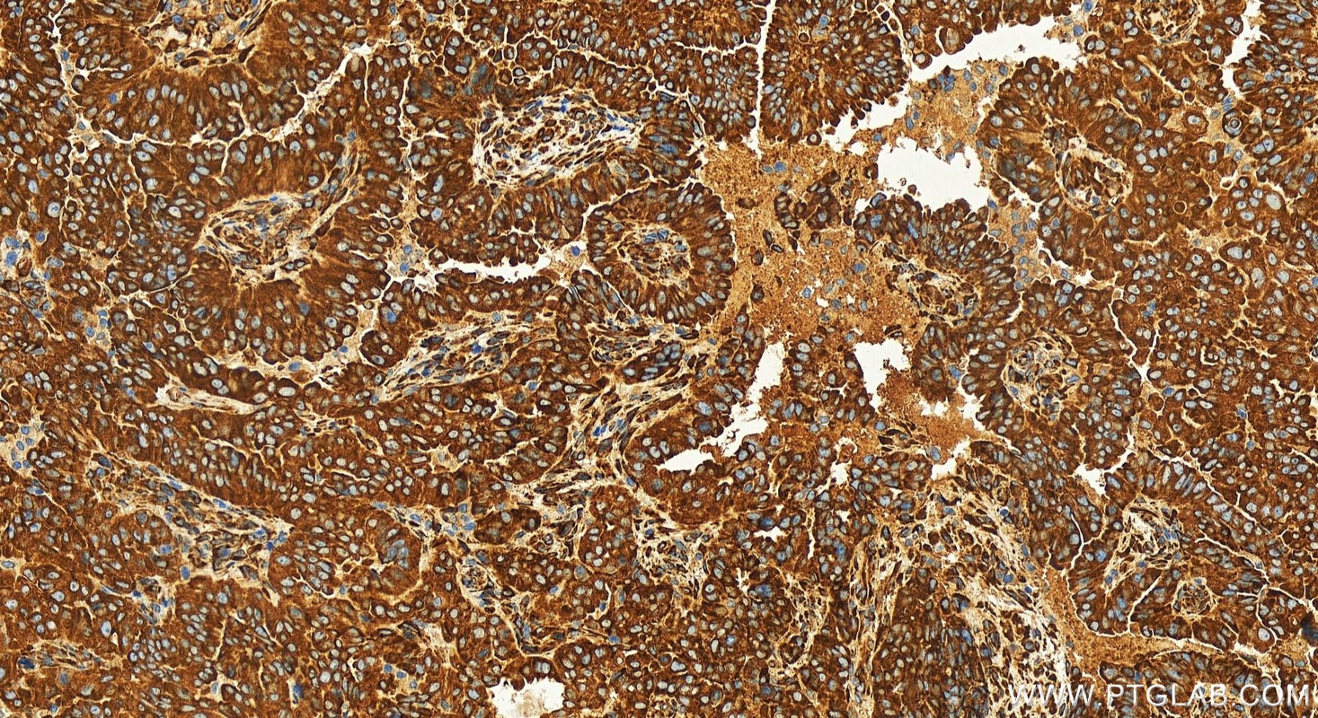 Immunohistochemistry (IHC) staining of human ovarian  cancer using HSP47/SERPINH1 Recombinant antibody (83689-4-RR)