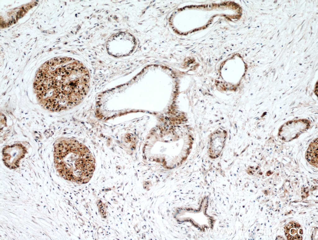 Immunohistochemistry (IHC) staining of human pancreas cancer tissue using HSPA4 Polyclonal antibody (21206-1-AP)