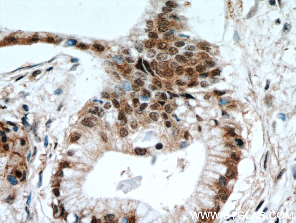 Immunohistochemistry (IHC) staining of human pancreas cancer tissue using HSPA4 Polyclonal antibody (21206-1-AP)