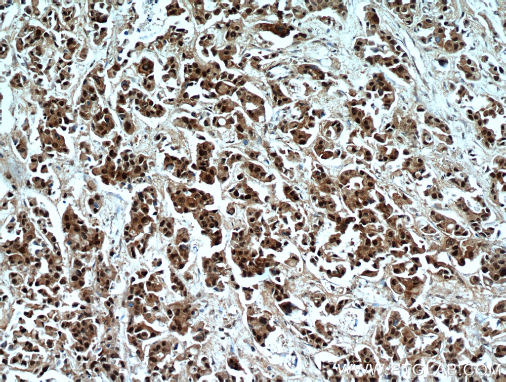 Immunohistochemistry (IHC) staining of human breast cancer tissue using HSPA4 Polyclonal antibody (21206-1-AP)