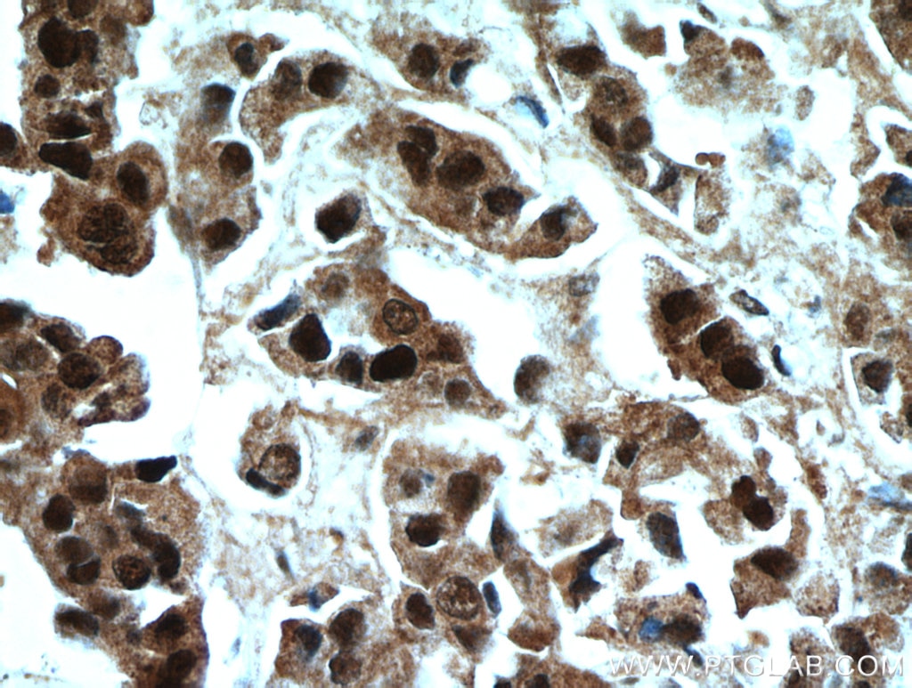 Immunohistochemistry (IHC) staining of human breast cancer tissue using HSPA4 Polyclonal antibody (21206-1-AP)